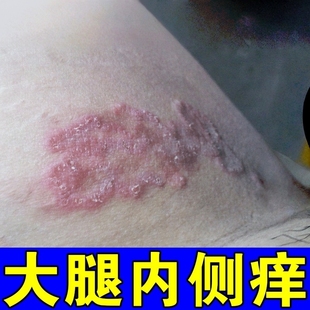 大腿内侧皮肤发痒药去男士私处腹股沟长红斑屁股湿痒痘痘特膏药效