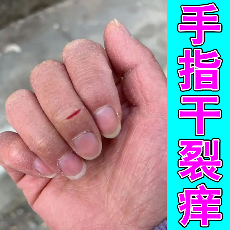 手裂口干裂修复霜秋季指甲缝干裂皮肤消毒护理（消）