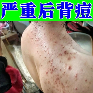 治前胸后背痘痘马拉色菌毛囊专用后背炎肩膀发红发痒长小疙瘩软膏
