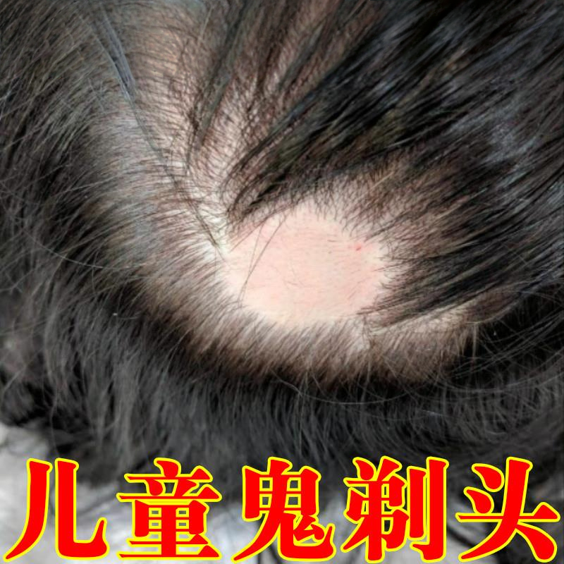 斑秃效特鬼剃头药干性脂溢脱发一抹灵谢顶生姜生发液增发洗发水