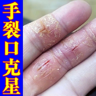 治手裂的药膏手指头裂口子干燥粗糙手掌心裂开防干裂爆干皮护手霜