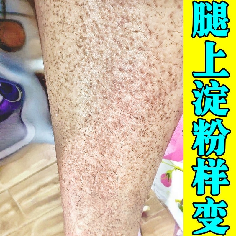 皮肤淀粉样变专用膏药疗顽固全身小腿皮肤粗糙颗粒干痒皮痒修复膏