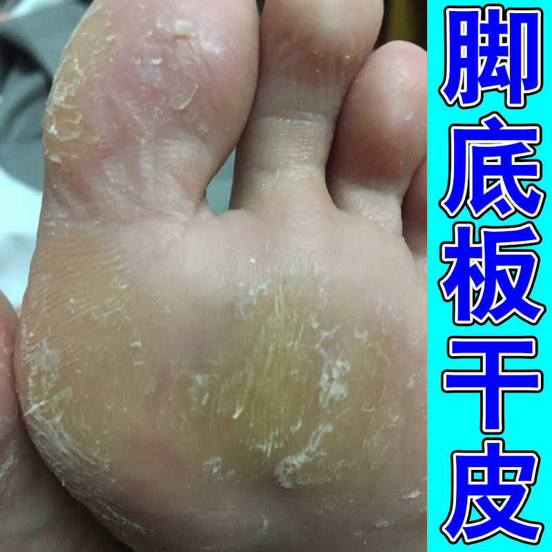 脚底板粗干燥皮肤硬皮脚趾缝痒草木软膏