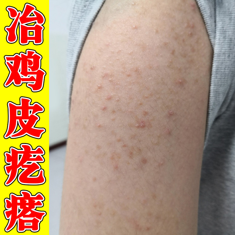 手臂毛囊胳膊上长小疙瘩鸡皮毛囊皮肤消毒护理（消）