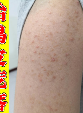 手臂毛囊胳膊上长小疙瘩鸡皮毛囊角化专用去除颗粒