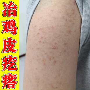 手臂毛囊胳膊上长小疙瘩鸡皮毛囊角化专用去除颗粒