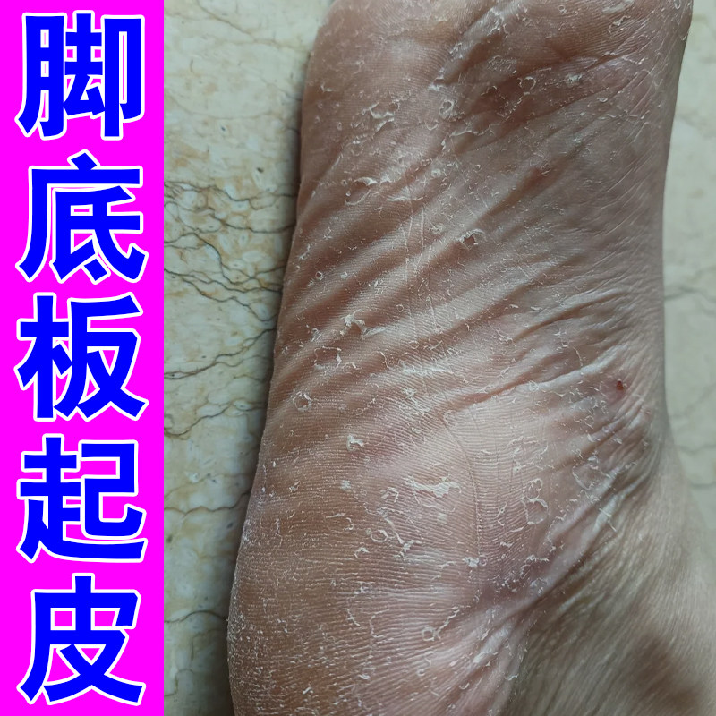 脚底板小水泡粗糙干燥脚底板起干皮草木软膏