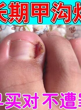 甲沟有息肉去除嵌甲脚趾甲往肉里长红肿疼痛流脓专用修复膏