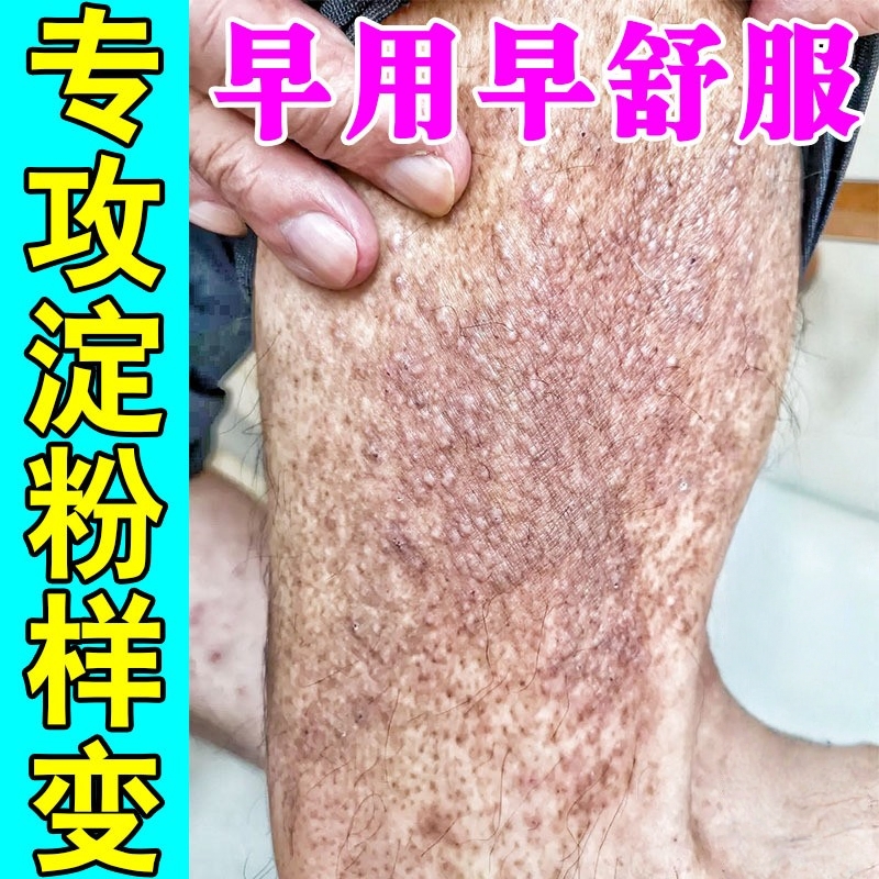 皮肤淀粉样变专用膏药治疗顽固身上皮痒斑状皮肤粗糙小颗粒修复膏
