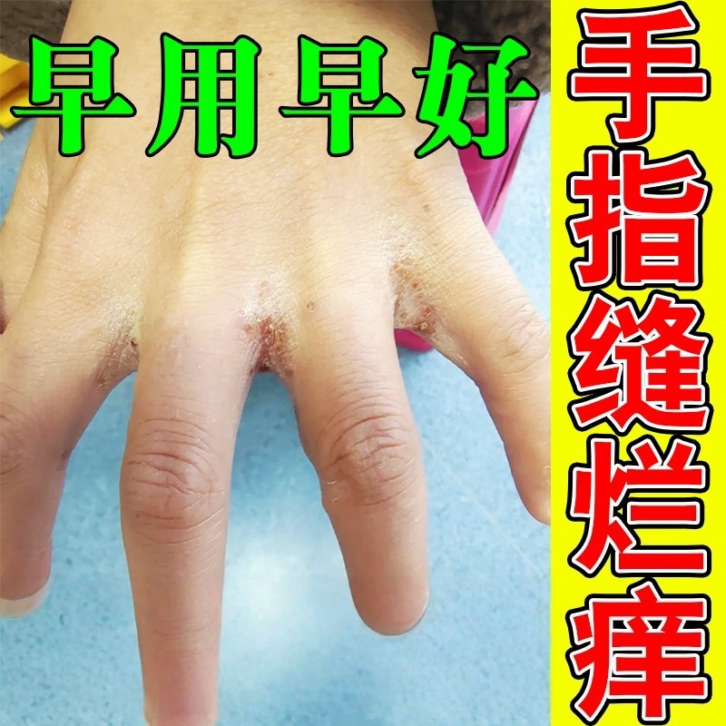 手指缝溃烂痒膏药皮肤干燥裂缝脱皮发痒烂手丫真菌感染专用修复膏
