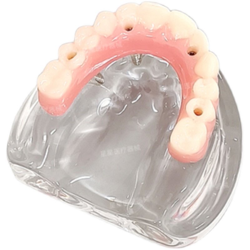 马龙连桥 义齿I种植修复模型