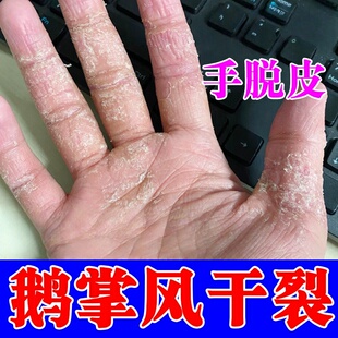 手蜕皮专用手痒膏手上脱皮干燥开裂起泡手足痒皮肤粗糙起皮蜕皮