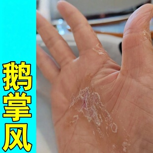 手蜕皮干裂脱皮软膏顽固性手痒干燥粗糙开裂角化型湿手气手痒疹