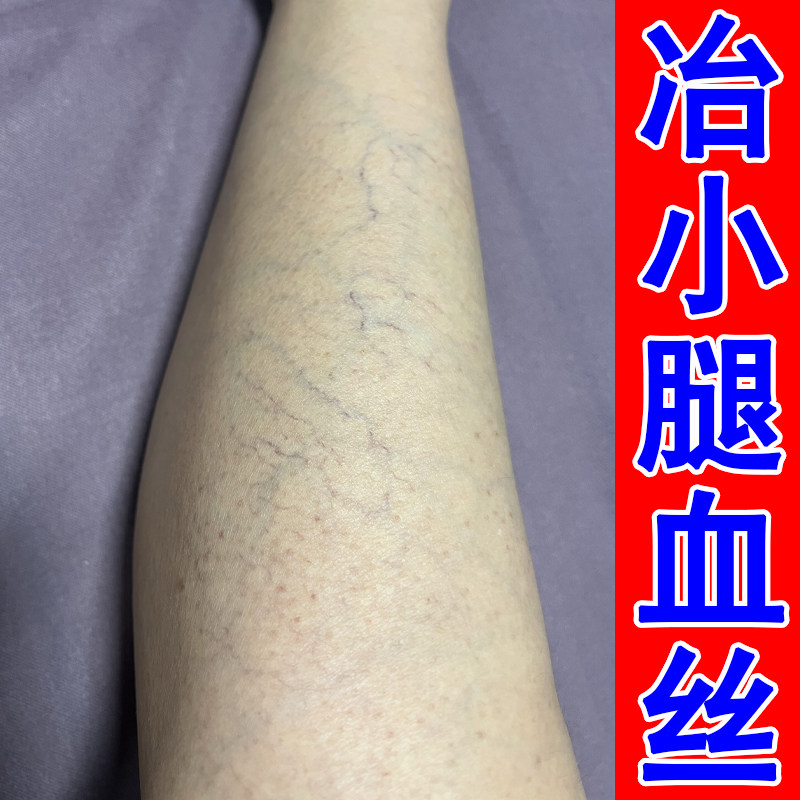 腿上有红血丝毛细血管扩张腿部青筋凸起肿胀外用修复血丝腿软膏