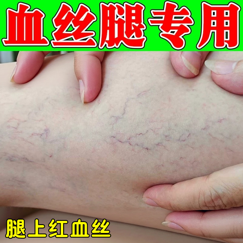 腿上有红血丝专用膏毛细血管堵塞皮肤消毒护理（消）