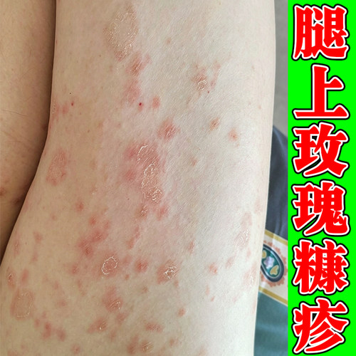 腿上长玫瑰糠疹圆形红斑鳞屑身上痒起红斑干痒脱皮起皮感染母斑痒