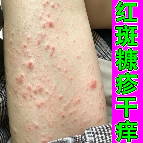 玫瑰糠疹专用腿上身上皮肤长红斑鳞屑干痒起皮掉屑长红疙瘩外用药