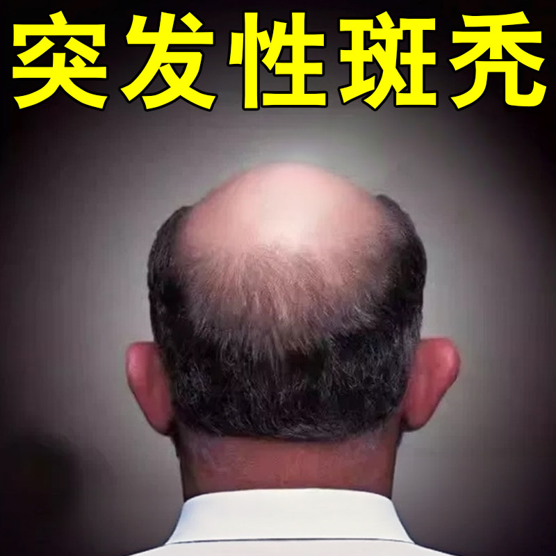 突发性斑秃鬼剃头圆形脱发斑块状皮肤消毒护理（消）
