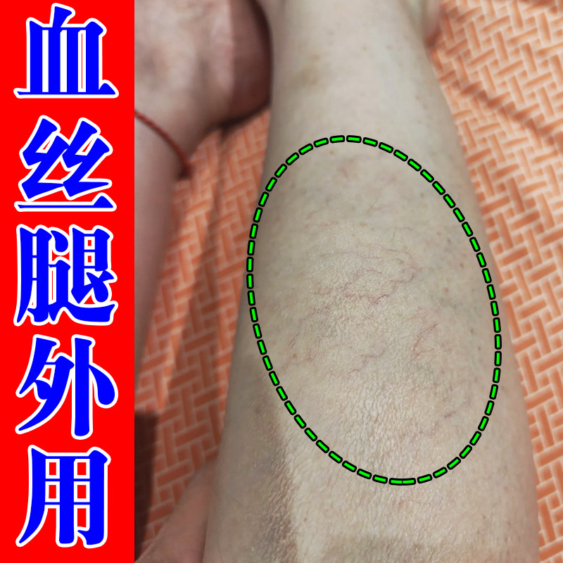 血丝腿外用修复腿上有红血丝毛细血管扩张男女通用手背青筋凸起药