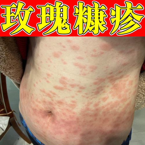 玫瑰糠疹专用皮肤痒起红斑过敏干痒粗糙肚子手臂疙瘩腿上长红斑药