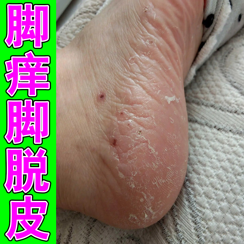 脚上脱皮脚底脚心掉皮脱皮专用膏脚皮肤粗糙干燥干裂手脚痒起皮药