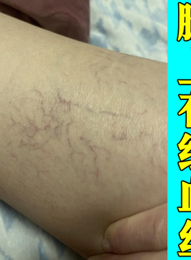 腿上有红血丝外用修复手背小腿四肢青筋凸起血丝腿软膏