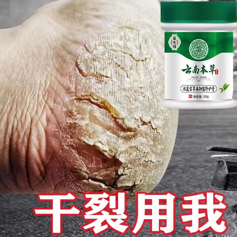 现货速发脚干裂脚后跟干燥裂口痒足跟粗糙开裂疼脚底硬化脚 感染