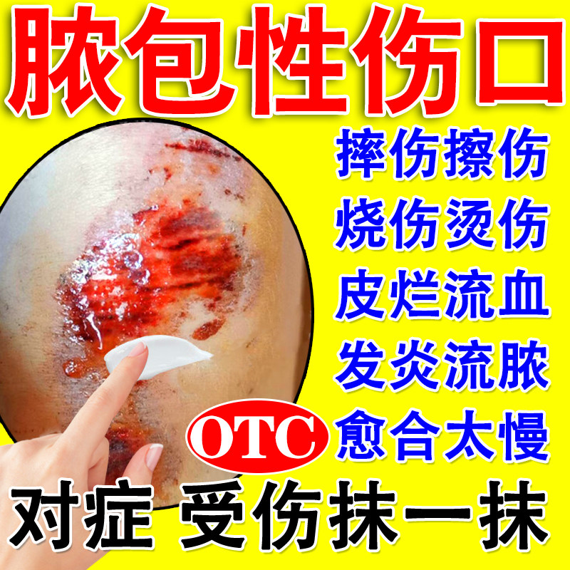 红霉素软膏正品消炎治伤口流脓感染溃疡面感染摔伤外伤烫伤擦伤膏