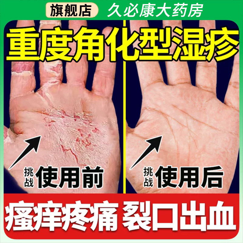 尿素维E乳膏治手足脱皮皲干裂真菌感染角化型湿疹手癣止痒药正品