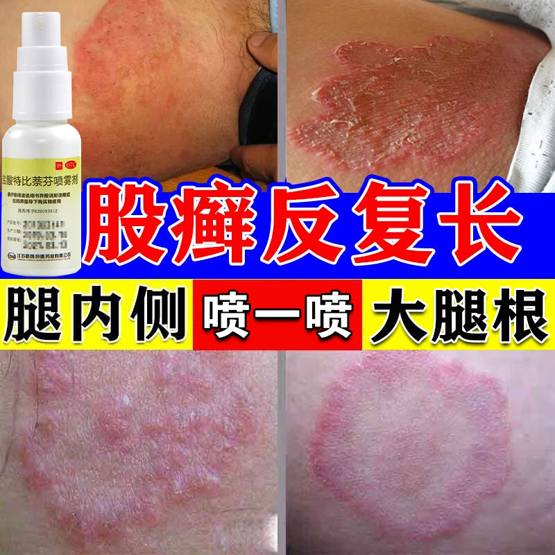 股藓专用药盐酸特比萘芬喷雾治疗去脚气止痒脱皮杀菌脚臭专用药膏