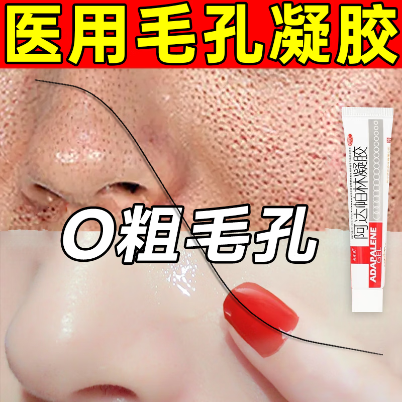 祛痘印修复淡化痘印青春痘祛痘药膏痤疮医用