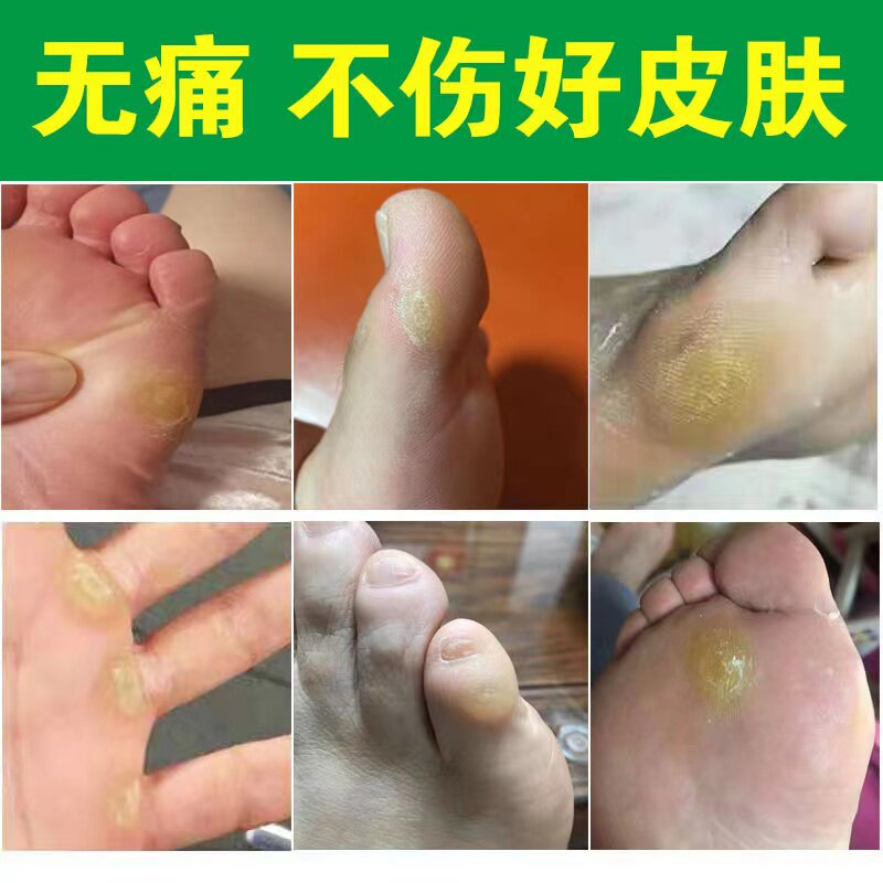 极速脚钉祛除膏去脚底根厚脚垫老茧洁士胼胝贴硬死皮软化剂脚丁药