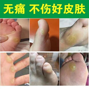 极速脚钉祛除膏去脚底根厚脚垫老茧洁士胼胝贴硬死皮软化剂脚丁药