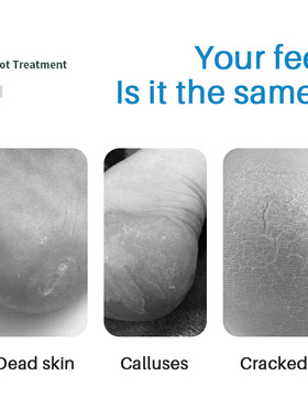 Callus Remover Gel Foot Peeling Spray Cuticles Removal Clean