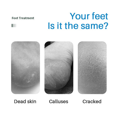 Callus Remover Gel Foot Peeling Spray Cuticles Removal Clean