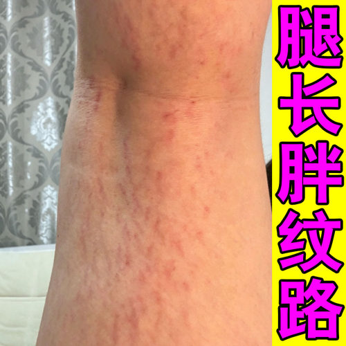 生长纹淡化大腿学生儿童去肥胖纹修复霜淡化纹路男女通用