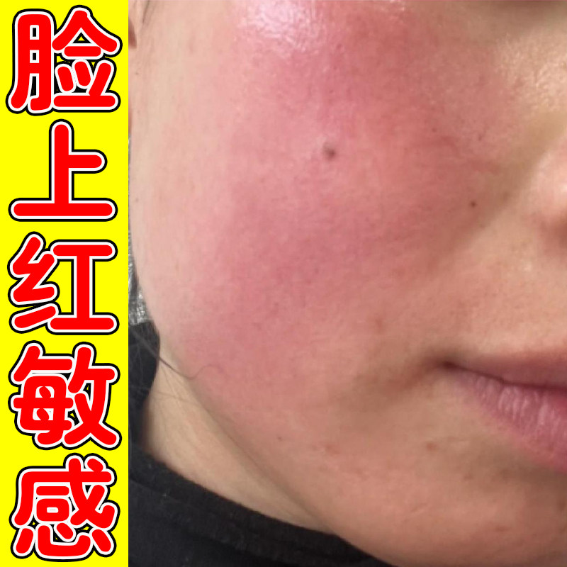脸颊上红血丝脸上红血丝泛红角质层薄过敏高原红草本修护软膏