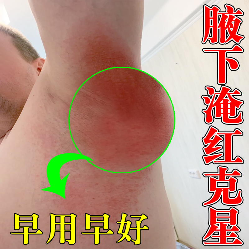 腋下淹红疼痛腋窝小疙瘩红斑湿痒胳肢窝淹了出汗痒腋下红肿淹红药
