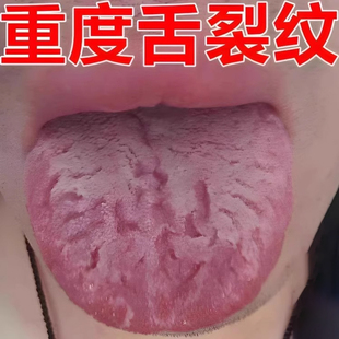 舌头裂痕裂纹舌地图舌齿痕疼痛灼口综合症舌头发白发厚舌头疼喷剂