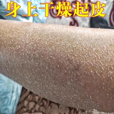 腿上干燥起皮小腿皮肤痒秋冬天起皮掉皮屑腿部鱼鳞补水保湿修复霜