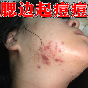 腮边起痘痘红肿疙瘩脸上长痘闭口粉刺脓包痘熬夜上火腮帮子长痘膏