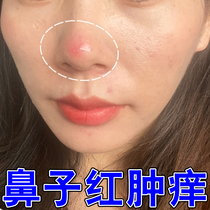 鼻子红肿鼻尖长脓包痘痘灼热刺痛发痒溢脂性过敏酒糟鼻草莓鼻软膏