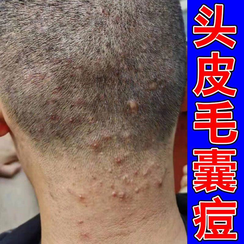 头上长痘痘头痒专用膏脂溢性头皮结痂长疙瘩硬块去前胸后背痘