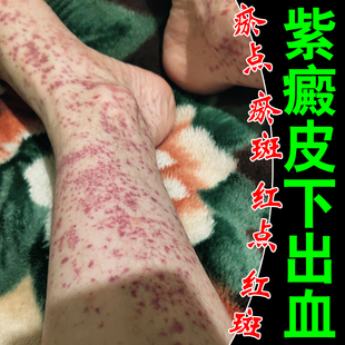 紫皮下出皮肤紫瘀点瘀斑红点红斑紫外用