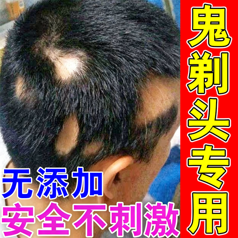 鬼剃头药儿童斑秃生发液后头发成皮肤消毒护理（消）
