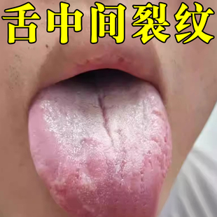 舌头裂痕裂纹舌地图舌齿痕灼口综合症舌头发白发厚舌头裂口疼喷剂