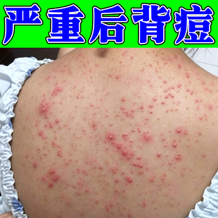 后背痘痘红肿脓包疙瘩背后长痘痘马拉色菌毛囊炎外用软膏
