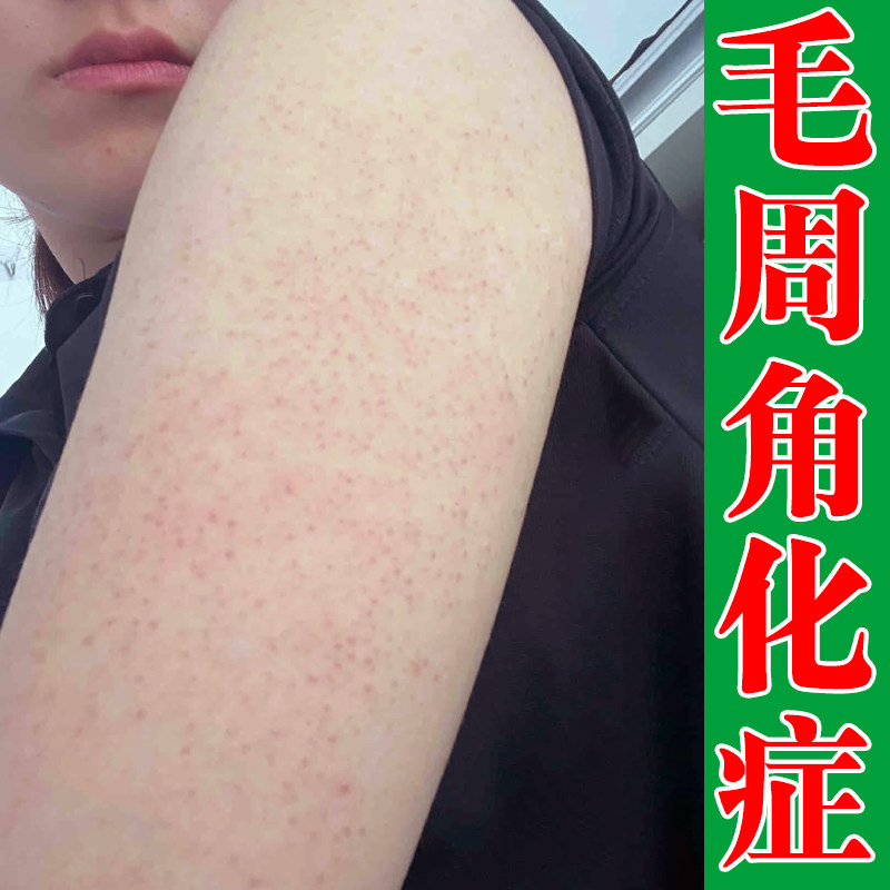 手臂起小红点疙瘩毛周毛囊堵塞皮肤摸起来粗糙长小颗粒