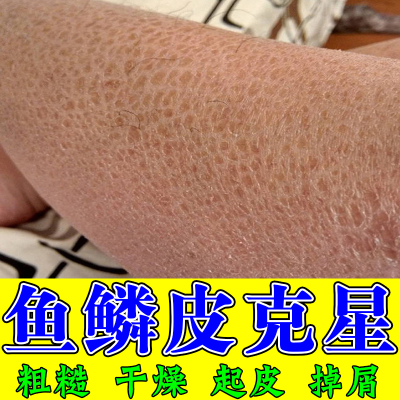 鱼鳞皮克星皮肤粗糙干燥起皮掉屑蛇皮肤斑状纹理干痒粗糙鱼鳞病霜