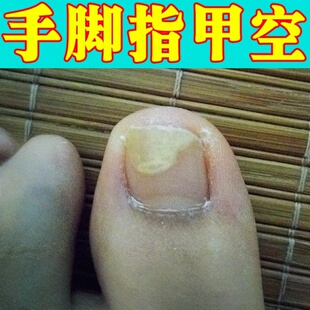 专治空指甲手脚趾甲变空发黄硬增厚真菌性白甲床分离断层萎缩